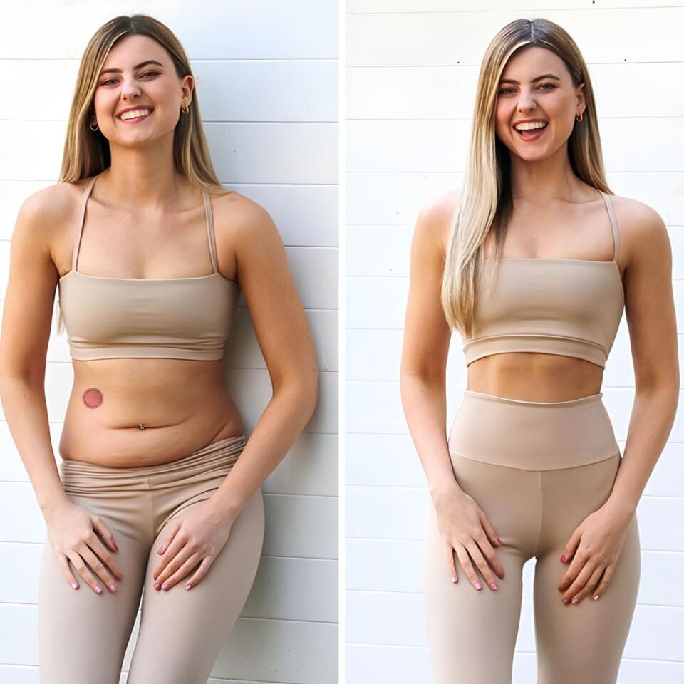 Purelora ACV Patches image